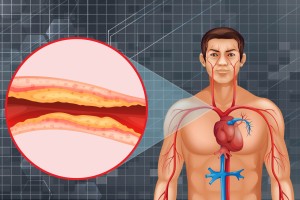 Cholesterol