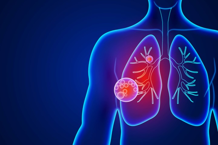 Pneumonia